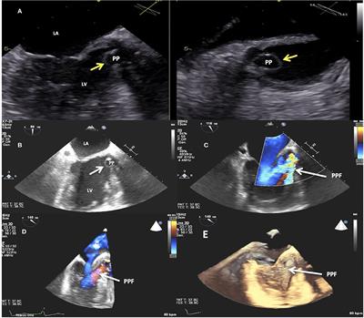 Catheter-based Closure of a Post-infective Aortic Paravalvular Pseudoaneurysm Fistula With Severe Regurgitation After Two Valve Replacement Surgeries: A Case Report